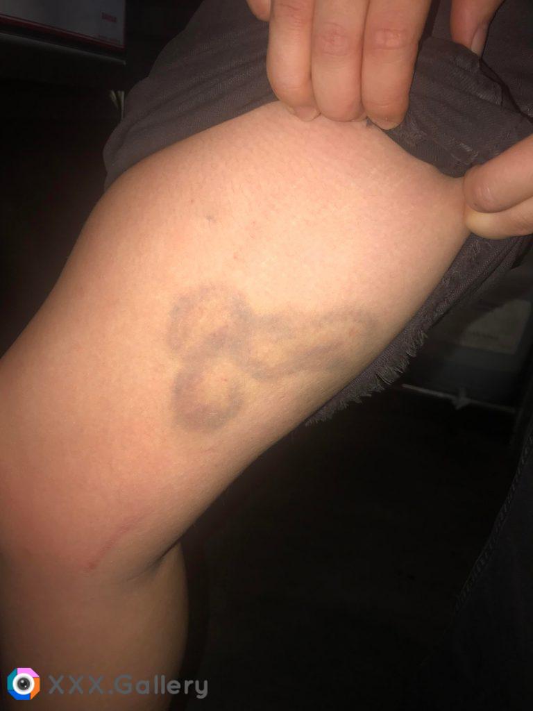 This NSFW bruise on my workmate!